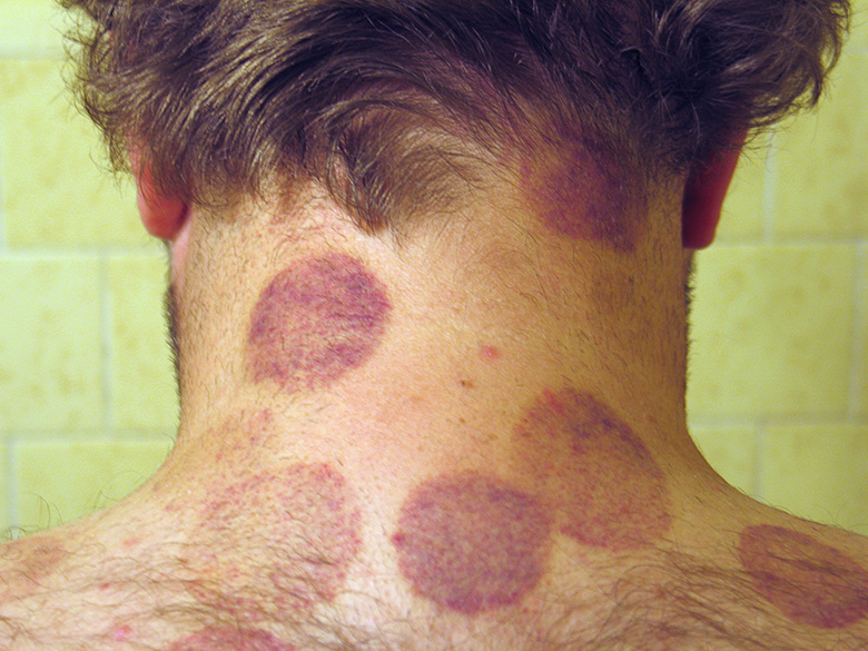 bruised neck